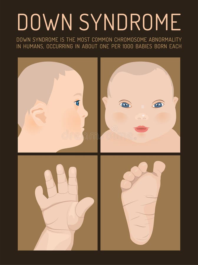 Giù sintomi di Syndrom royalty illustrazione gratis Giù sintomi di Syndrom royalty illustrazione gratis