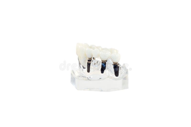 Glass Jaw Model with Implanted Dentures Stock Image Image of dental