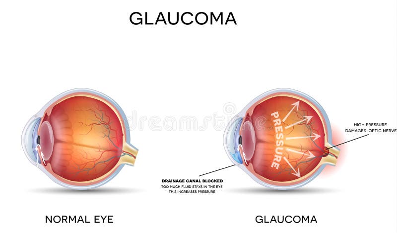 Glaucoma. Detailed anatomy of Glaucoma and healthy eye.