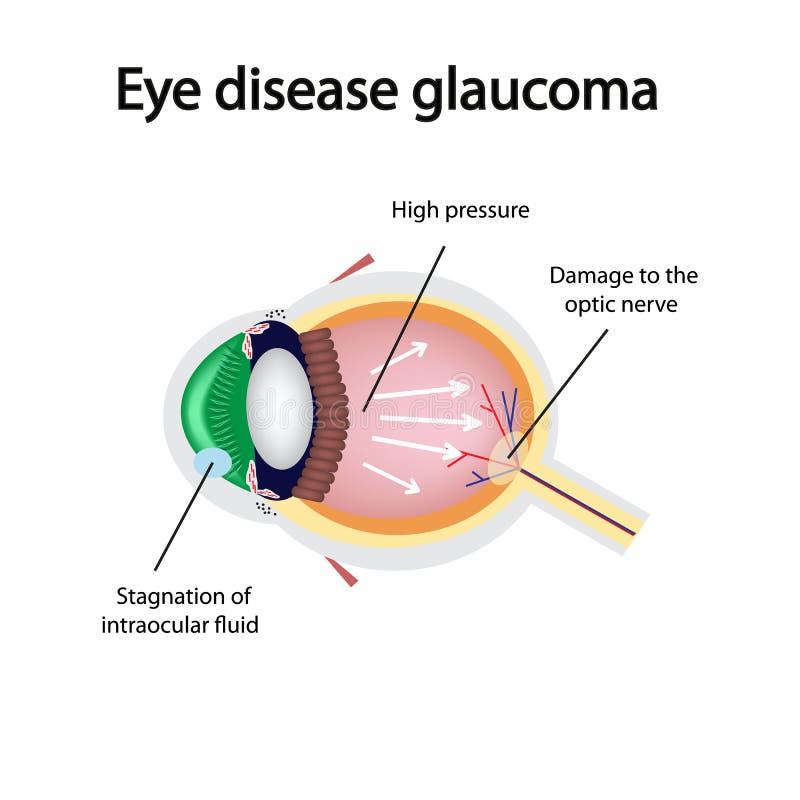 Glaucomatous eye. Violations causing glaucoma stock illustration Glaucomatous eye. Violations causing glaucoma stock illustration