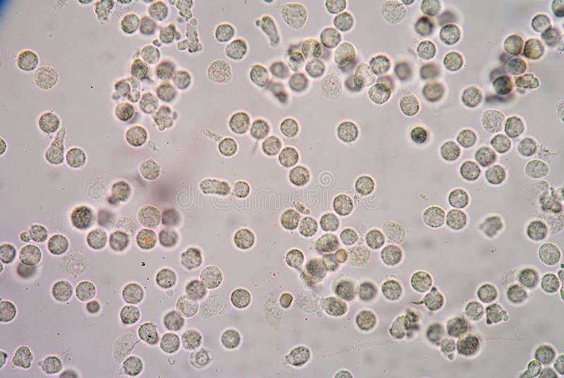 Globule blanc dans les urines photos