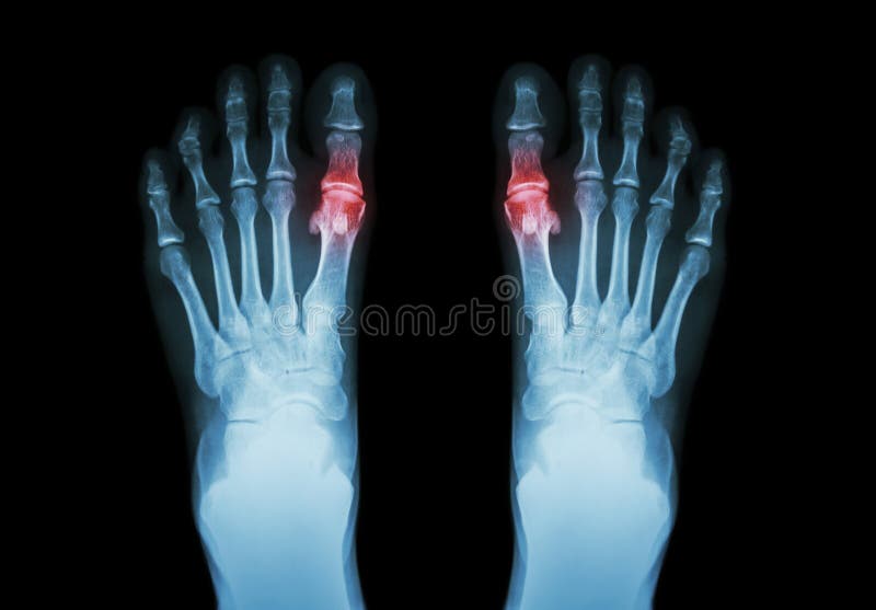 Gotta, artrite reumatoide (piede che artrite dei raggi x del film sia al primo giunto metatarso-falangeo) (backg di scienza e del
