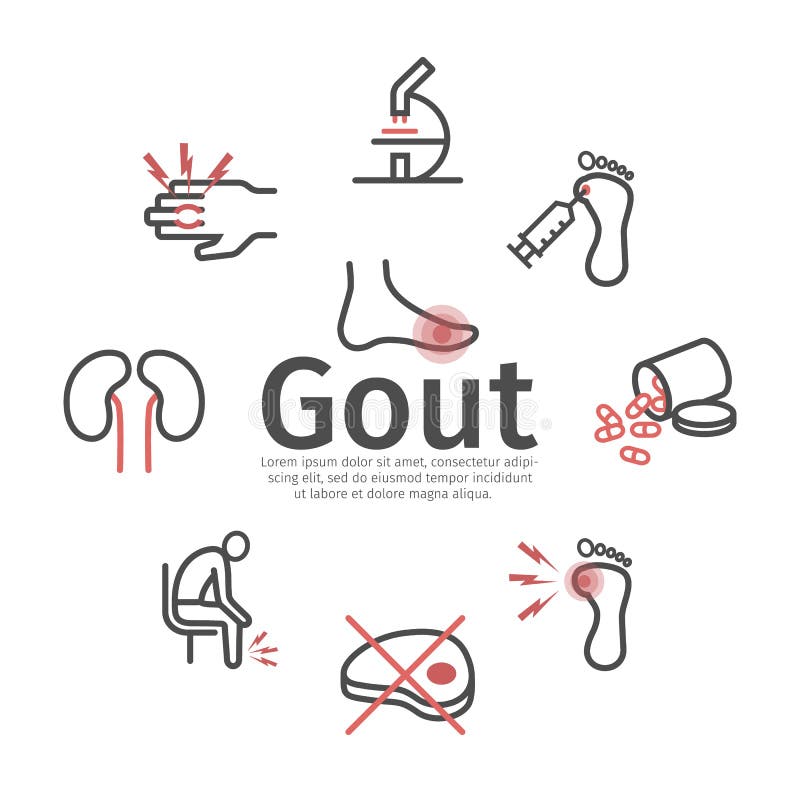 Treatment gout Diagnosis, Treatment,