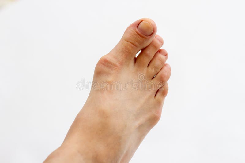 Gout On The Bones Of The Foot Isolated Stock Image Image of sick