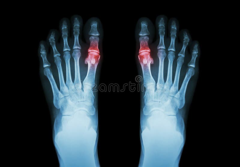 , reumatoide artritis ( ambos pierna a artritis sobre el el primero articulación ) ( a ciencia ) 