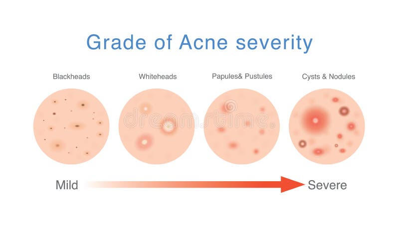 Grade of acne severity. Medical diagram about skin problems from acne.