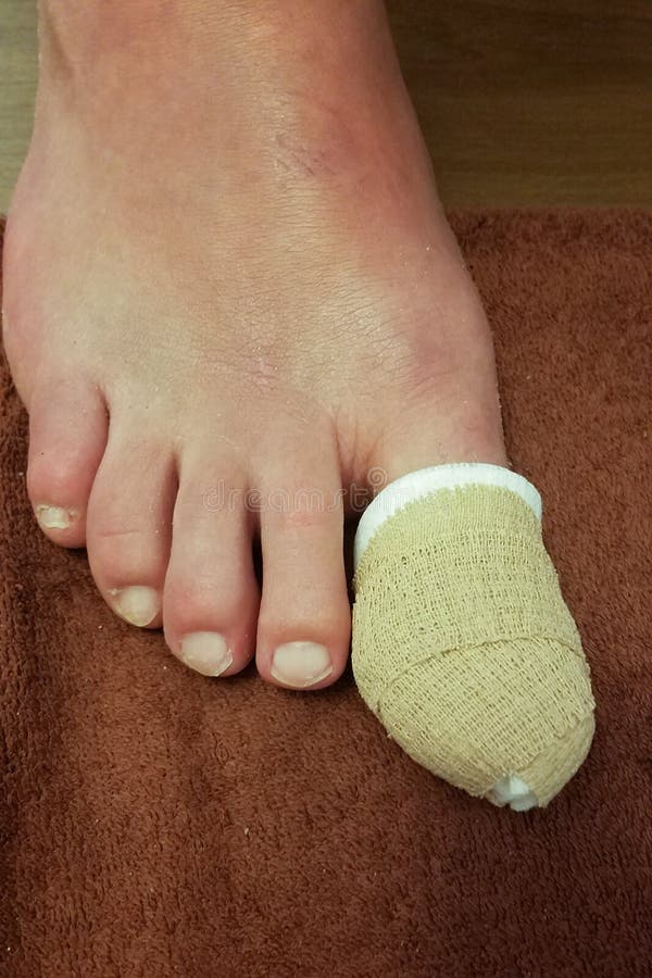 Grande Toe Injury Wrapped E Protegido Imagem de Stock Imagem de edema