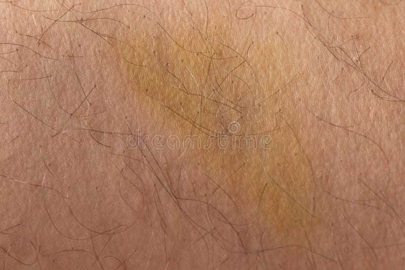 Green bruise on human skin stock photo. Image of spot 281009182