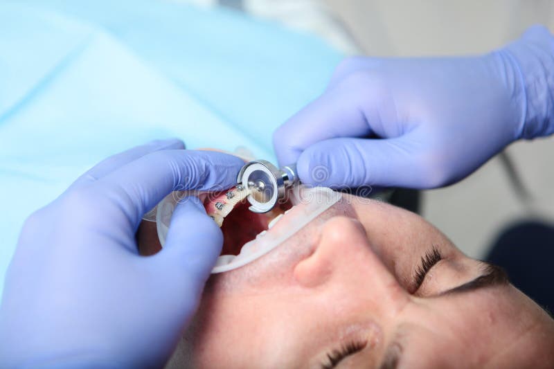 Grinding of Tooth Enamel. Separation of Teeth. Correction of the