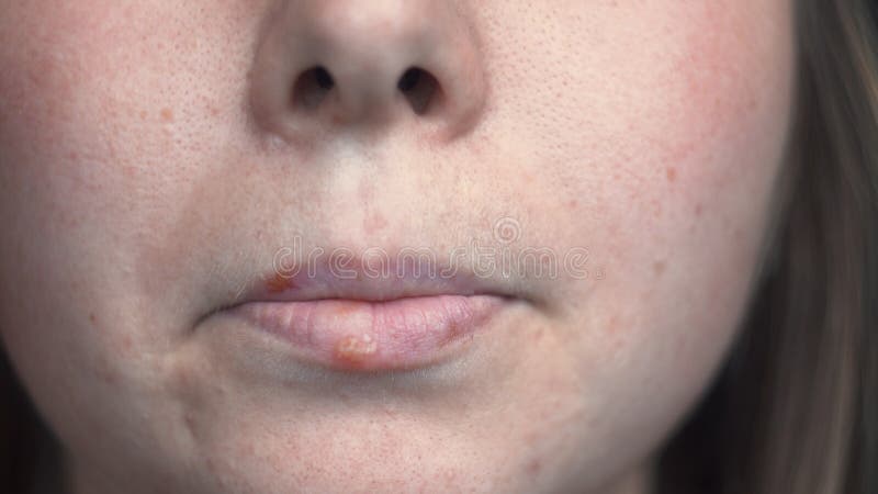 Gros plan sur la peau des femmes sur le problème avec l'herpès sur les lèvres. Médias. Peau wellgroomed du visage avec des taches