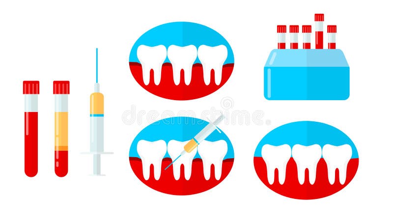 Grupo de PRP, plasma rico da plaqueta na odontologia Dente, goma do sangramento, seringa, centrifugador Ilustração do vetor no es ilustração stock Grupo de PRP, plasma rico da plaqueta na odontologia Dente, goma do sangramento, seringa, centrifugador Ilustração do vetor no es ilustração stock