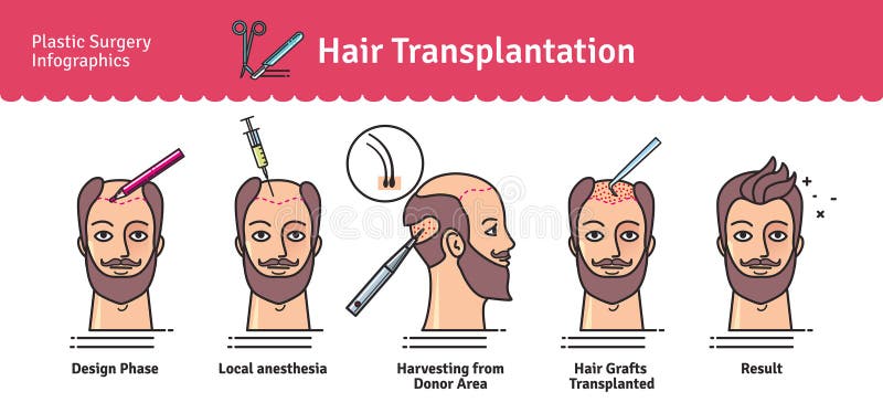 Grupo ilustrado vetor com cirurgia de transplantação do cabelo ilustração stock Grupo ilustrado vetor com cirurgia de transplantação do cabelo ilustração stock