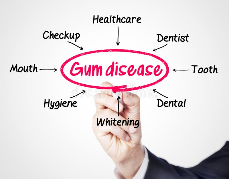 Gum disease royalty free stock photography Gum disease royalty free stock photography