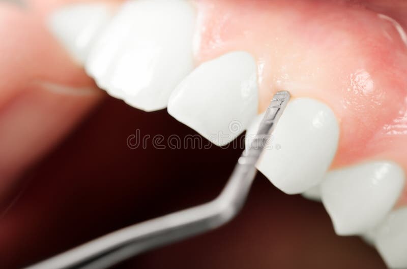 Gums examination equipment. Close up royalty free stock photo Gums examination equipment. Close up royalty free stock photo