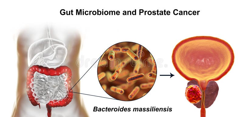 How prostate cancer develops