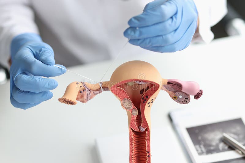 Doctor gynecologist ligates fallopian tubes on example of layout female reproductive system. Contraception concept for unwanted pregnancy. Doctor gynecologist ligates fallopian tubes on example of layout female reproductive system. Contraception concept for unwanted pregnancy