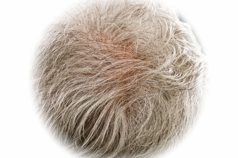 Haaruitval stock fotografie