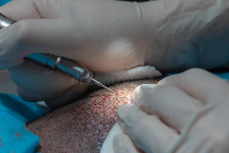 Hair Implant Process, Collecting Hair Plasma for Implanting Process