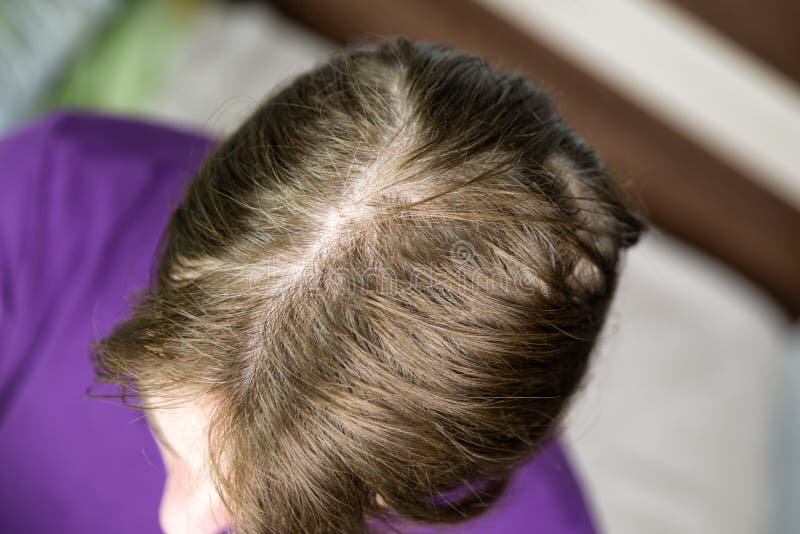 Hair loss female stock photo. Image of beauty, alopecia - 137901720 Hair loss female stock photo. Image of beauty, alopecia - 137901720