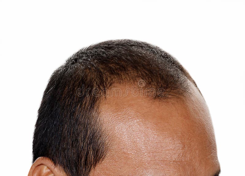 Hair loss , Male stock photo. Image of front, father - 47380542