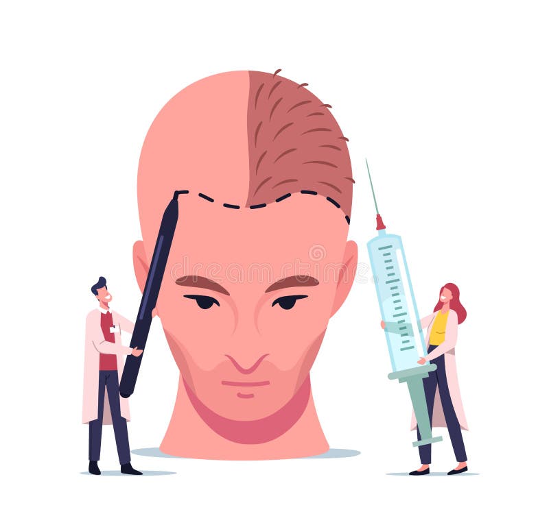 Hair Loss and Receding Health Problem. Tiny Doctor Characters Prepare Huge Male Head for Hair Transplantation Procedure