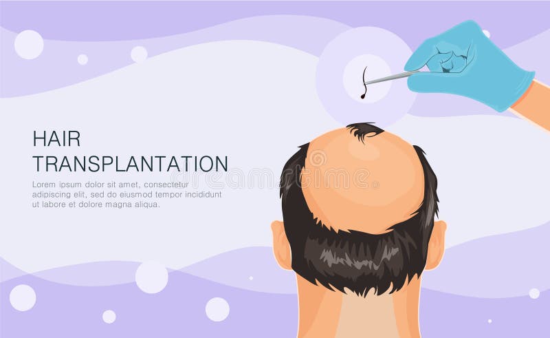Hair Loss. Stages of Alopecia Man Problem Vector Medical Health  Illustration Hair Transplant Illustration Stock Vector - Illustration of  medical, bald: 153108501