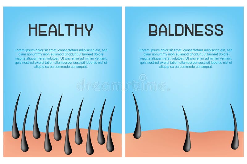 Hair Loss Stages Set of before and after Steps. Side View of a Man Losing  Hair before and after Hair Treatment and Stock Vector - Illustration of  condition, layer: 153729657