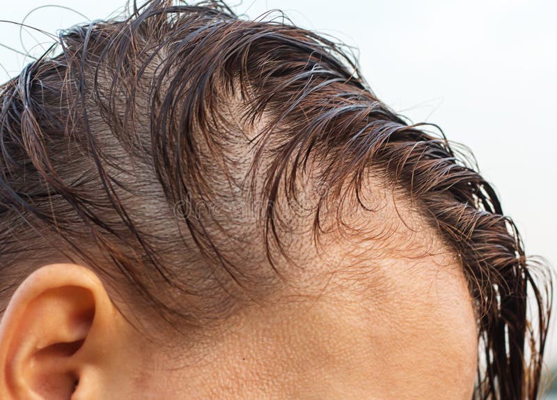 How to Deal with Postpartum Hair Loss