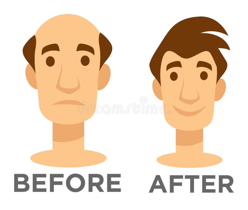 Hair Regrowth Stock Illustrations – 92 Hair Regrowth Stock Illustrations, Vectors & Clipart - Dreamstime Hair Regrowth Stock Illustrations – 92 Hair Regrowth Stock Illustrations, Vectors & Clipart - Dreamstime