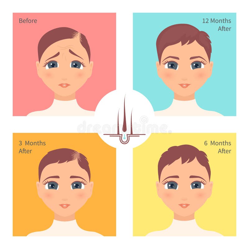 Hair Transplantation Surgery Result in Women after Three, Six and Twelve  Months Stock Vector - Illustration of hair, infographic: 174320842