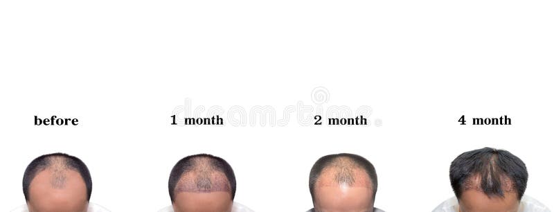 Hair Transplantation Surgery Steps. Patient before and after the Procedure  Stock Illustration - Illustration of hair, loosing: 227655928