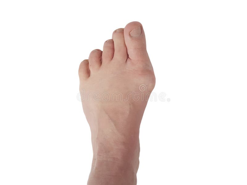 Hallux valgus-Deformation, Beine, lokalisierte Weiß, schmerzende Gelenke des Patienten lizenzfreies stockfoto Hallux valgus-Deformation, Beine, lokalisierte Weiß, schmerzende Gelenke des Patienten lizenzfreies stockfoto