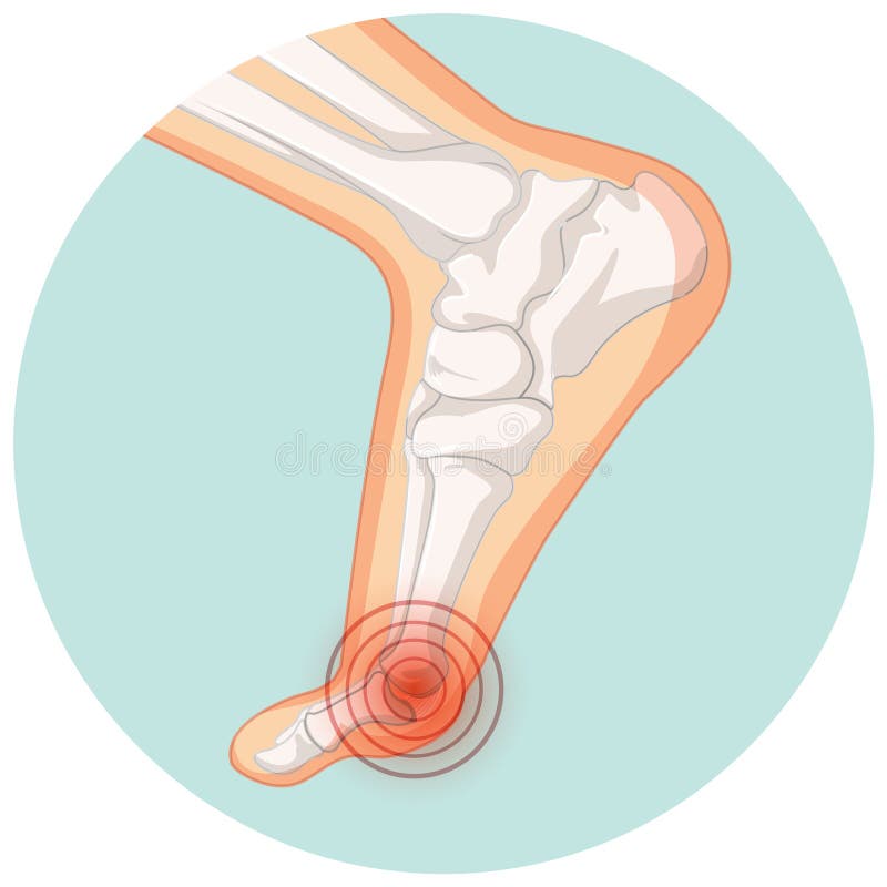 Hallux Valgus Types in Circle Template Stock Vector - Illustration of ...