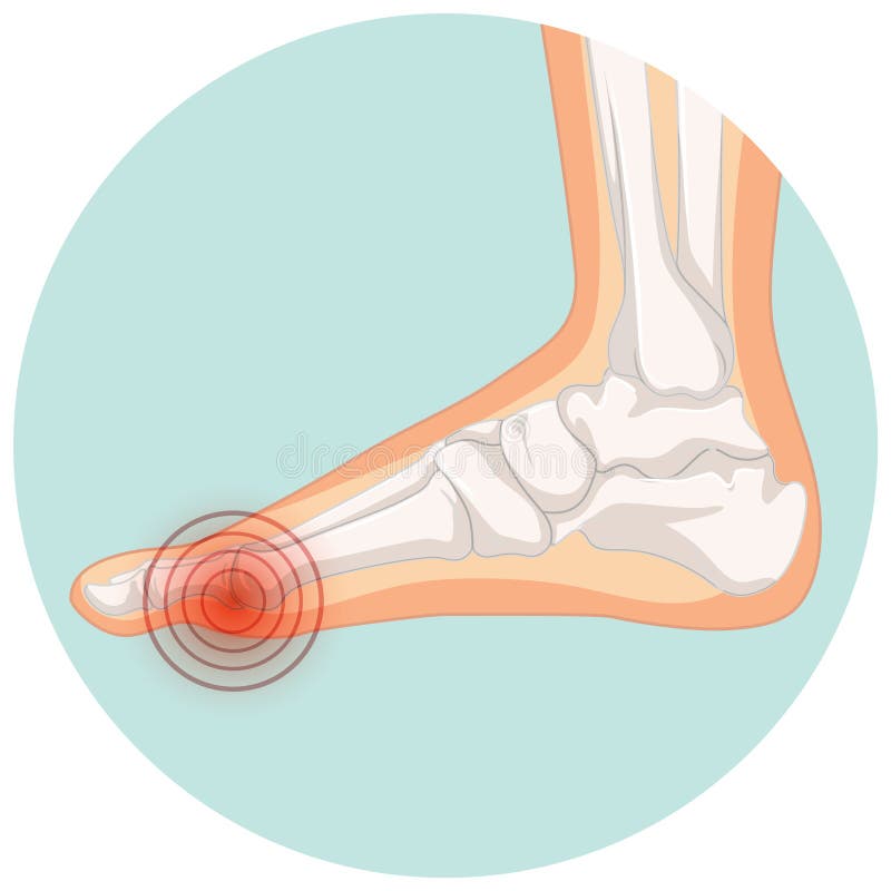 Hallux Valgus Types in Circle Template Stock Vector - Illustration of ...