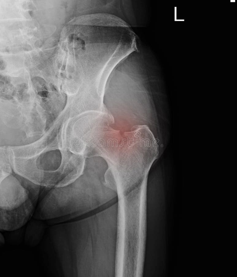 Hanche gauche de rayon X : cou laissé par fracture de fémur image libre de droits Hanche gauche de rayon X : cou laissé par fracture de fémur image libre de droits