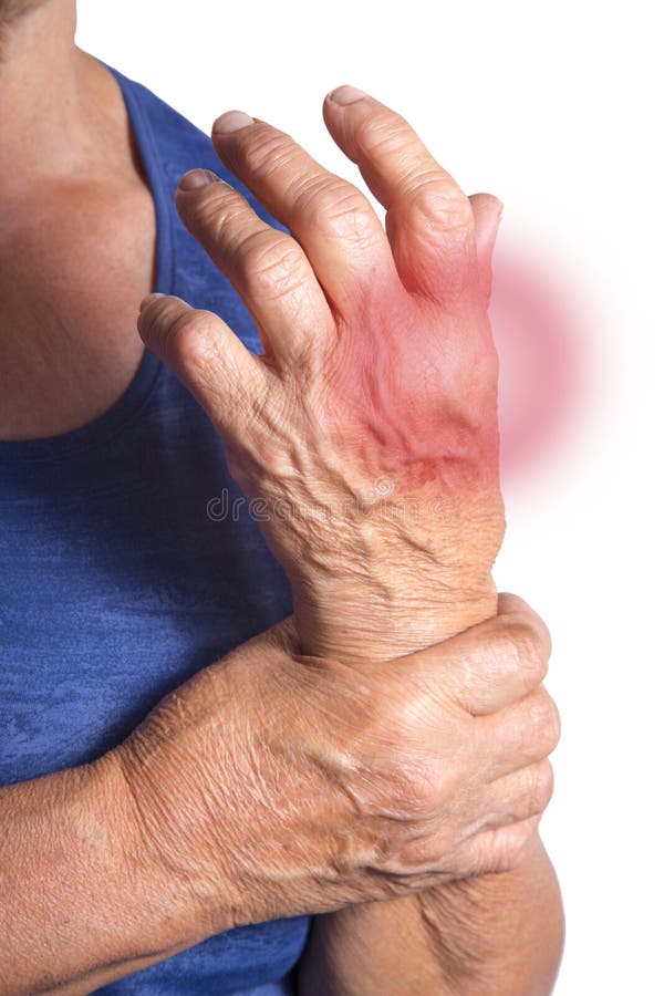 Hand Deformed from Rheumatoid Arthritis Stock Image Image of medical, rheumatoid 60116477