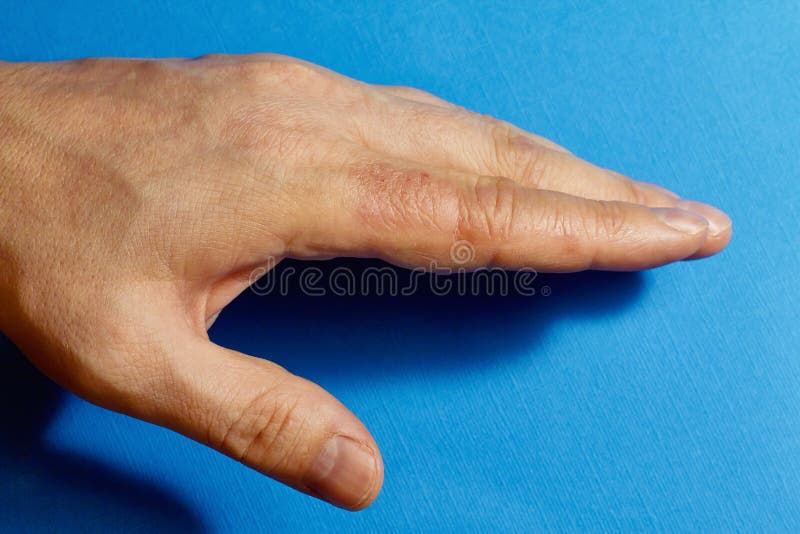 Mild Dermatitis Herpetiformis On Hands
