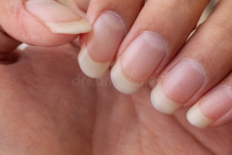 115 Hand Foot Syndrome Stock Photos Free & RoyaltyFree Stock Photos