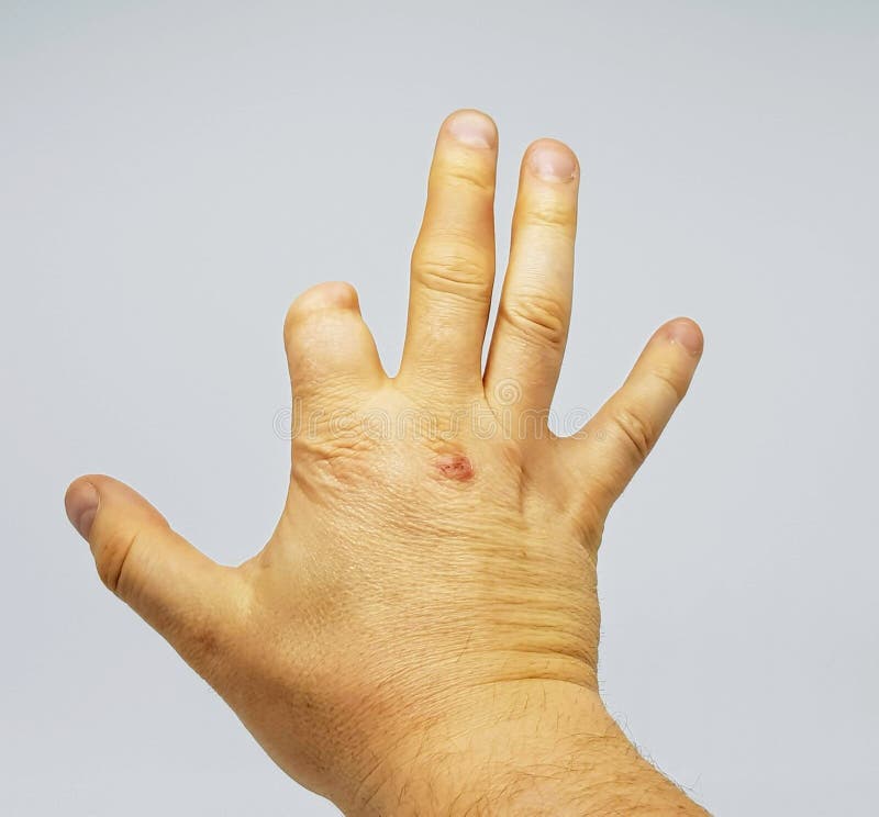 Hand Of A Person With A Part Of The Index Finger Missing Due To A Prior