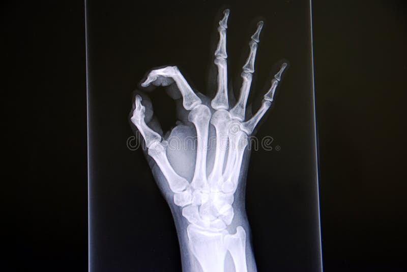 Hand X Ray stock photo. Image of investigate, bone, radius 14971722