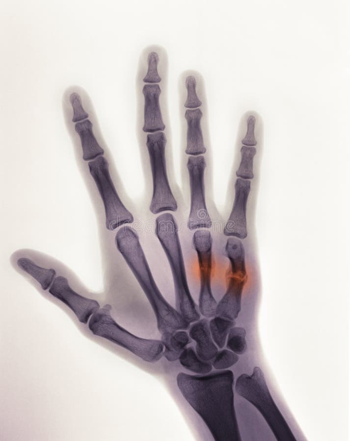 Hand Xray Showing a Boxer S Fracture Stock Photo Image of xray