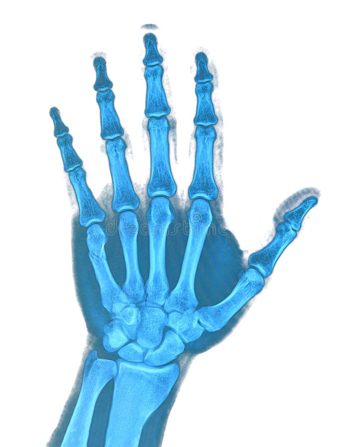 Xray of hand stock photo. Image of arthritis, anatomy 29974596