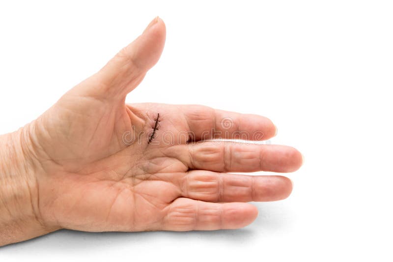 Hand surgery of a Dupuytren`s disease, contracture or a trigger