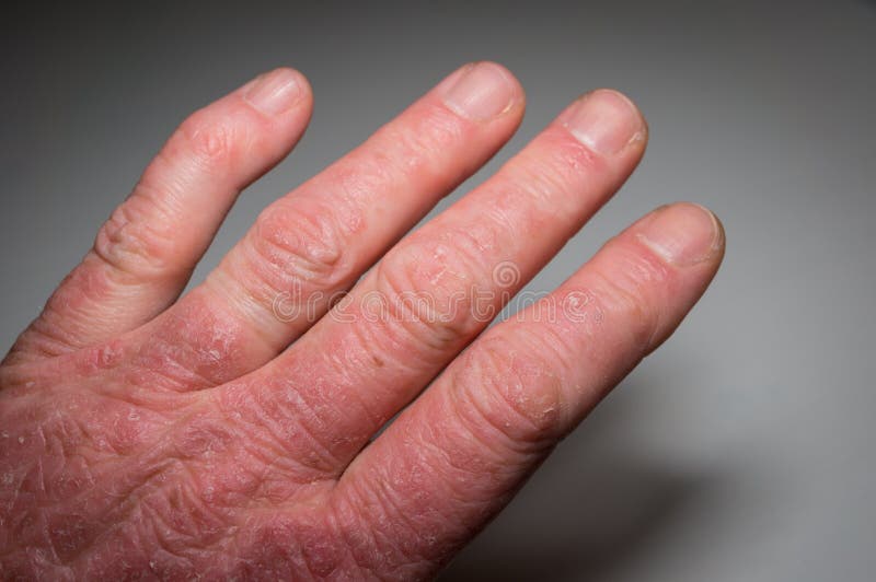 Hand van een patiënt die zich bij de behandeling van een psoriasis bevindt Artritis psoriatica Gewrichtsvervorming en ontsteking