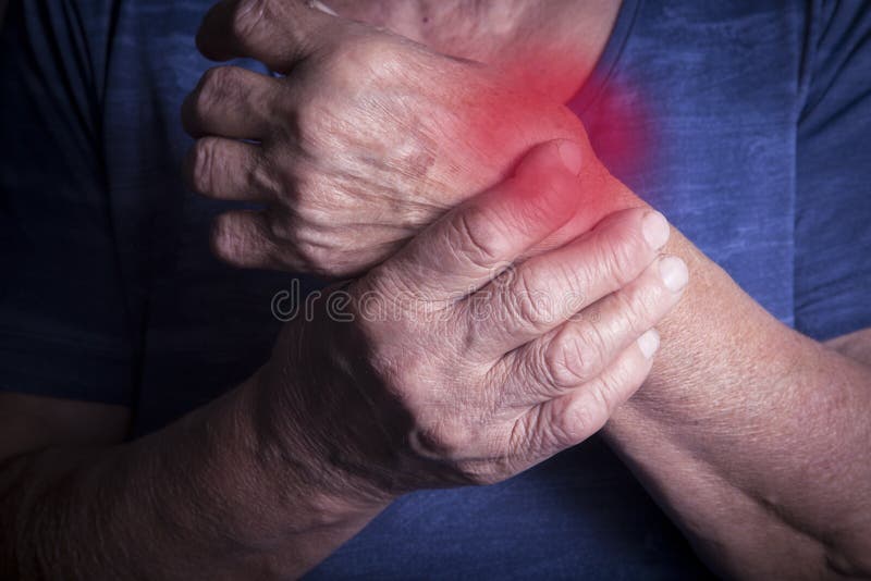 Hand van Reumatoïde Artritis wordt misvormd die