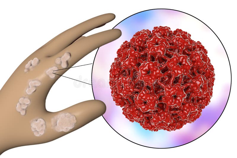Hand with Warts and Papillomavirus Stock Illustration Illustration of