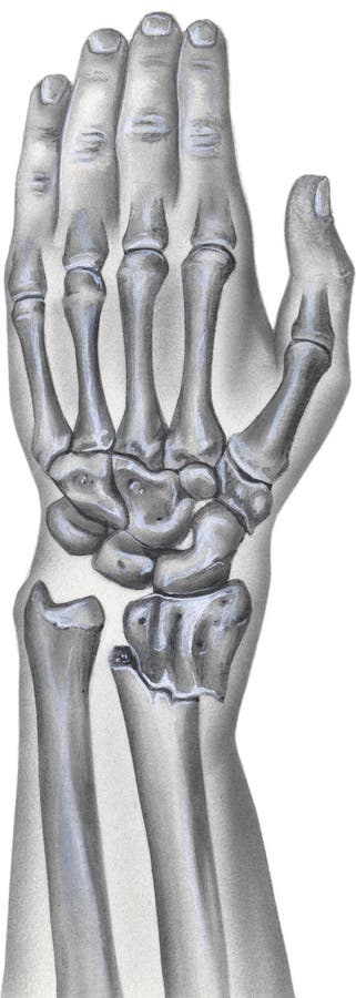 Hand and Wrist - Broken Radius Bone stock illustration