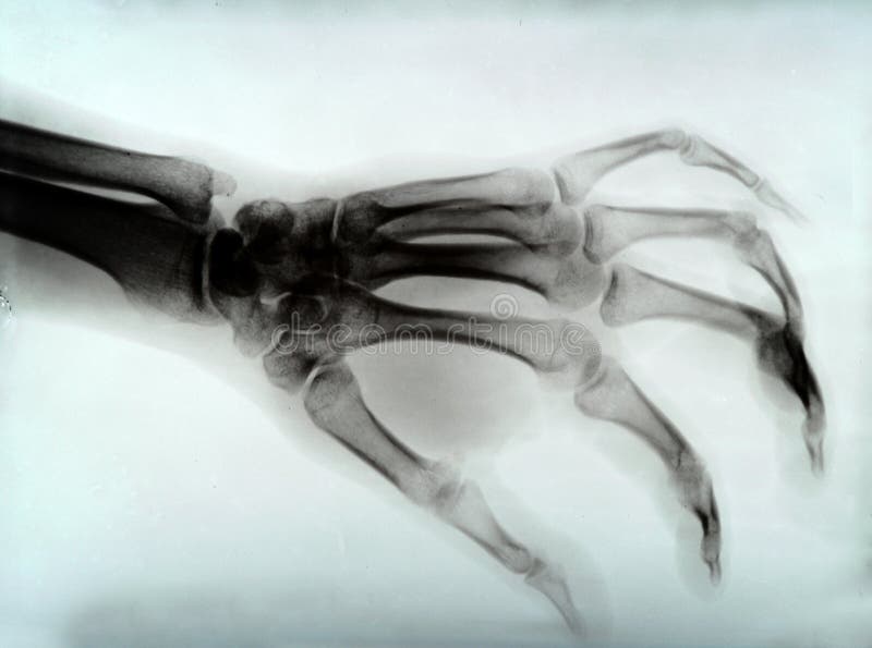 Broken Wrist, Arm With A Blue Fiberglass Cast Stock Image Image of