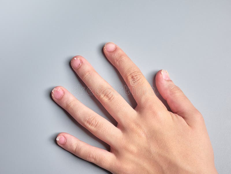 The Science of Brittle Nails: Causes and Proven Treatments – Nuu3