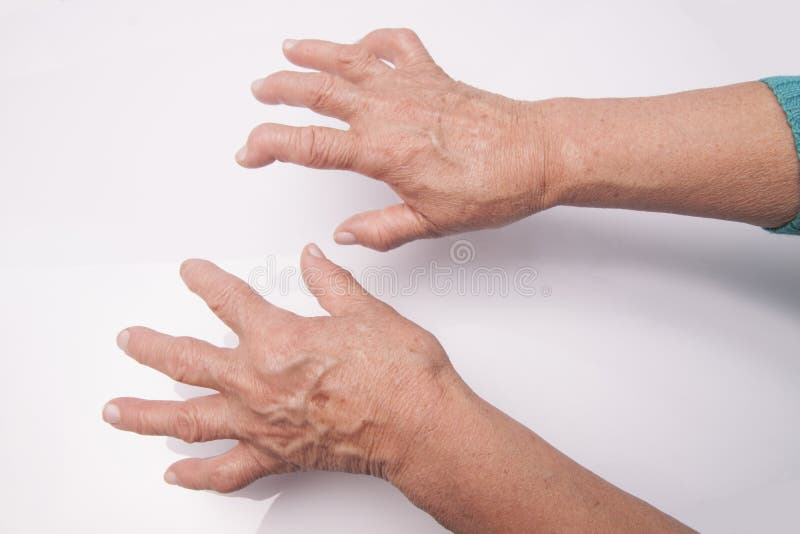 Handen met Reumatoïde Artritis